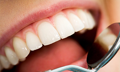 Professionelle Zahnreinigung, Prophylaxe in der Zahnarztpraxis und Pflege zu Hause sind die beste Vorsorge