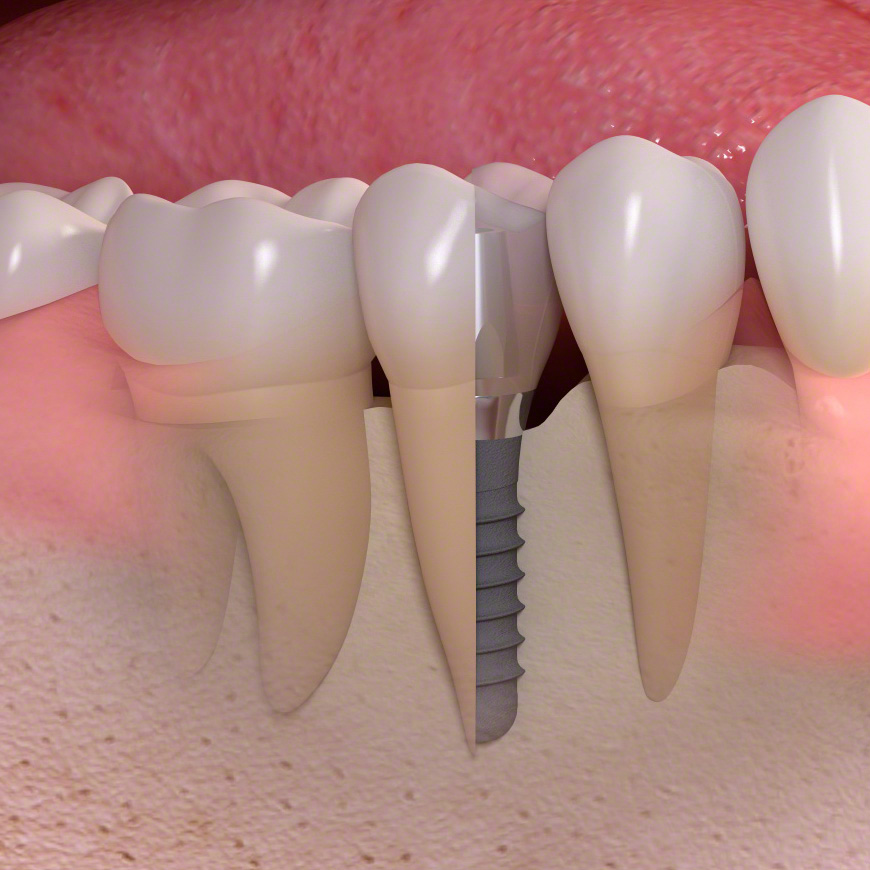 Implantate aus Titan: günstige Lösungen mit Titan Zahnimplantaten